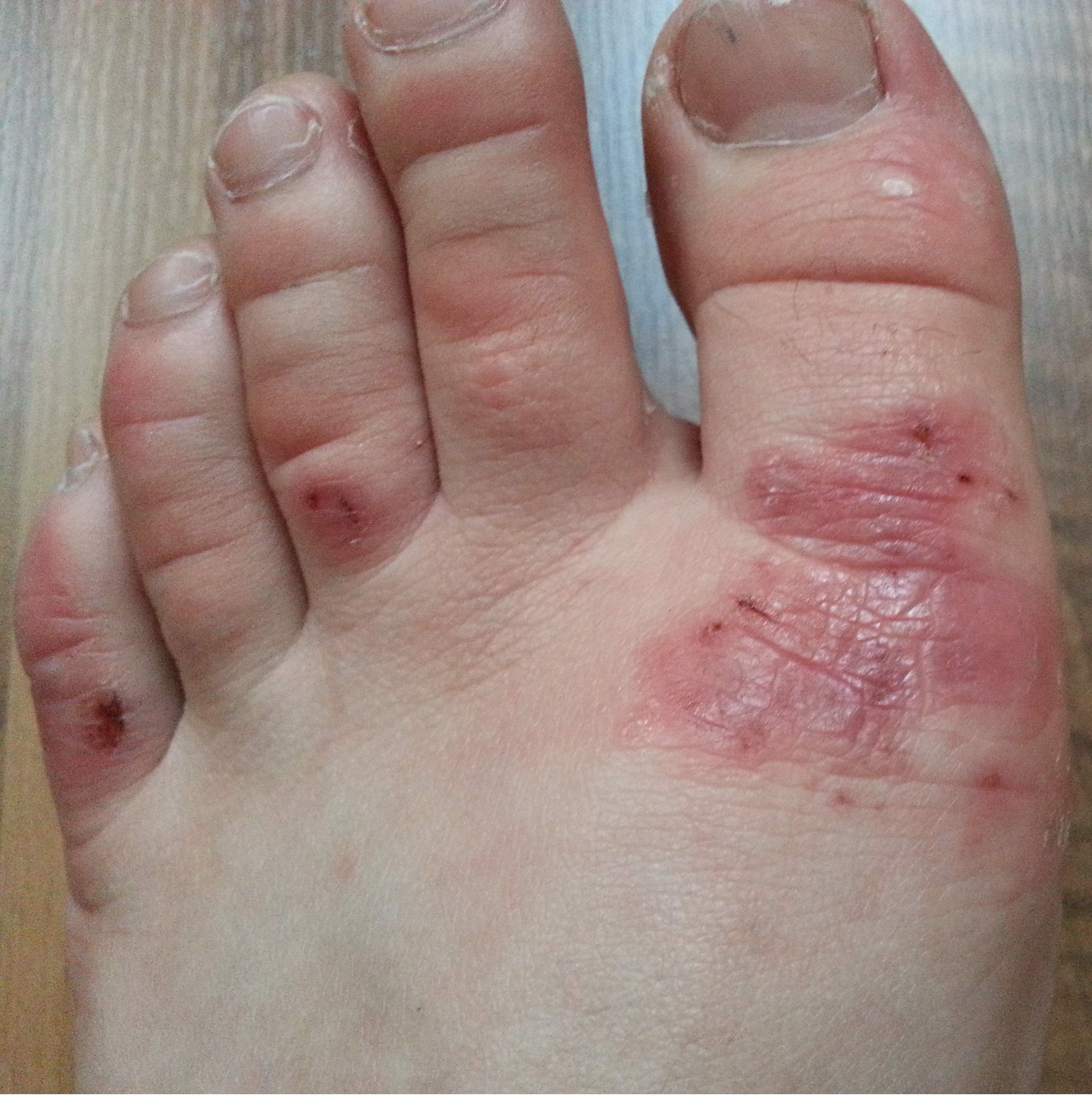 Wunden am Fuß!Ursachen? (Ernährung, Füße, Wunde) Wunden am Fuß!Ursachen? (Ernährung, Füße, Wunde)