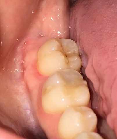 Zahn Entzundet Zahne Entzundung