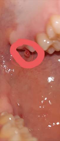 Zahnfleisch ball hängt unter Zahnfleisch?