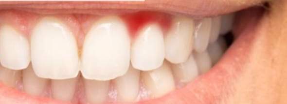 Zahnfleisch Entzundet Was Hilft Mundspulung Salzwasser Zahne Entzundung Zahnfleisch Entzundet Was Hilft Mundspulung Salzwasser Zahne Entzundung