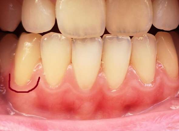 Zahnfleischentzündung oder sieht das noch normal aus?