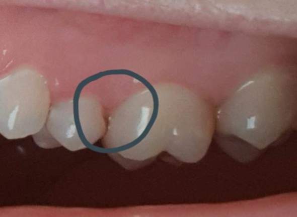 Zahnzwischenraum - dunkle Stelle Zahnfleisch?