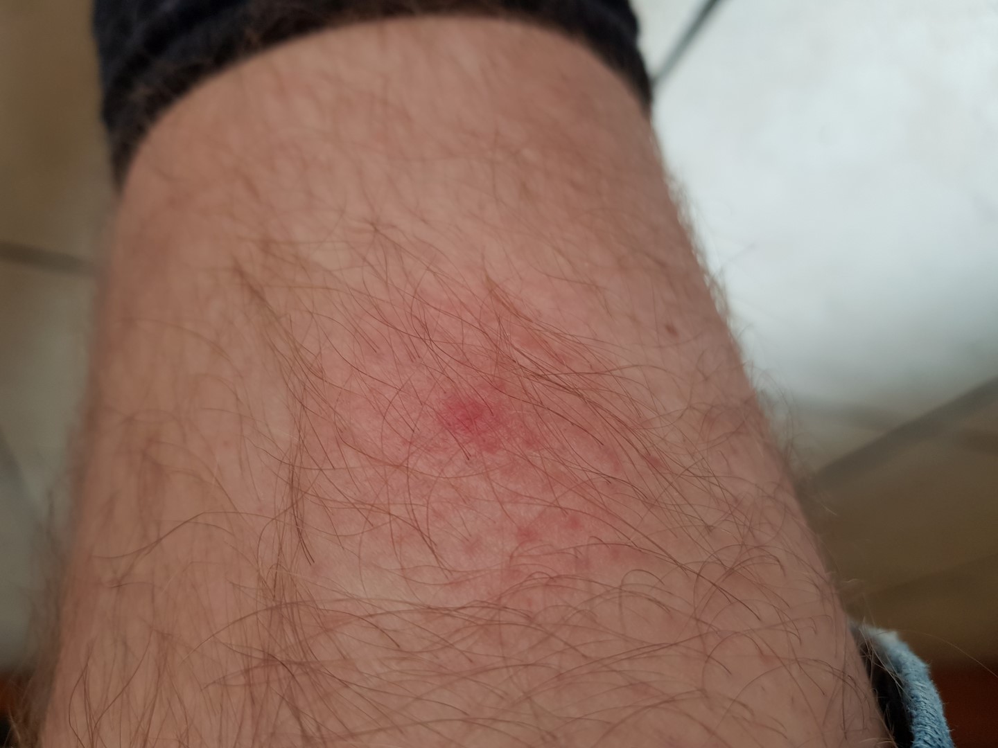 Zecken Stich erst Rötung jetzt Blauer Fleck nach 8 Tagen Borreliose A