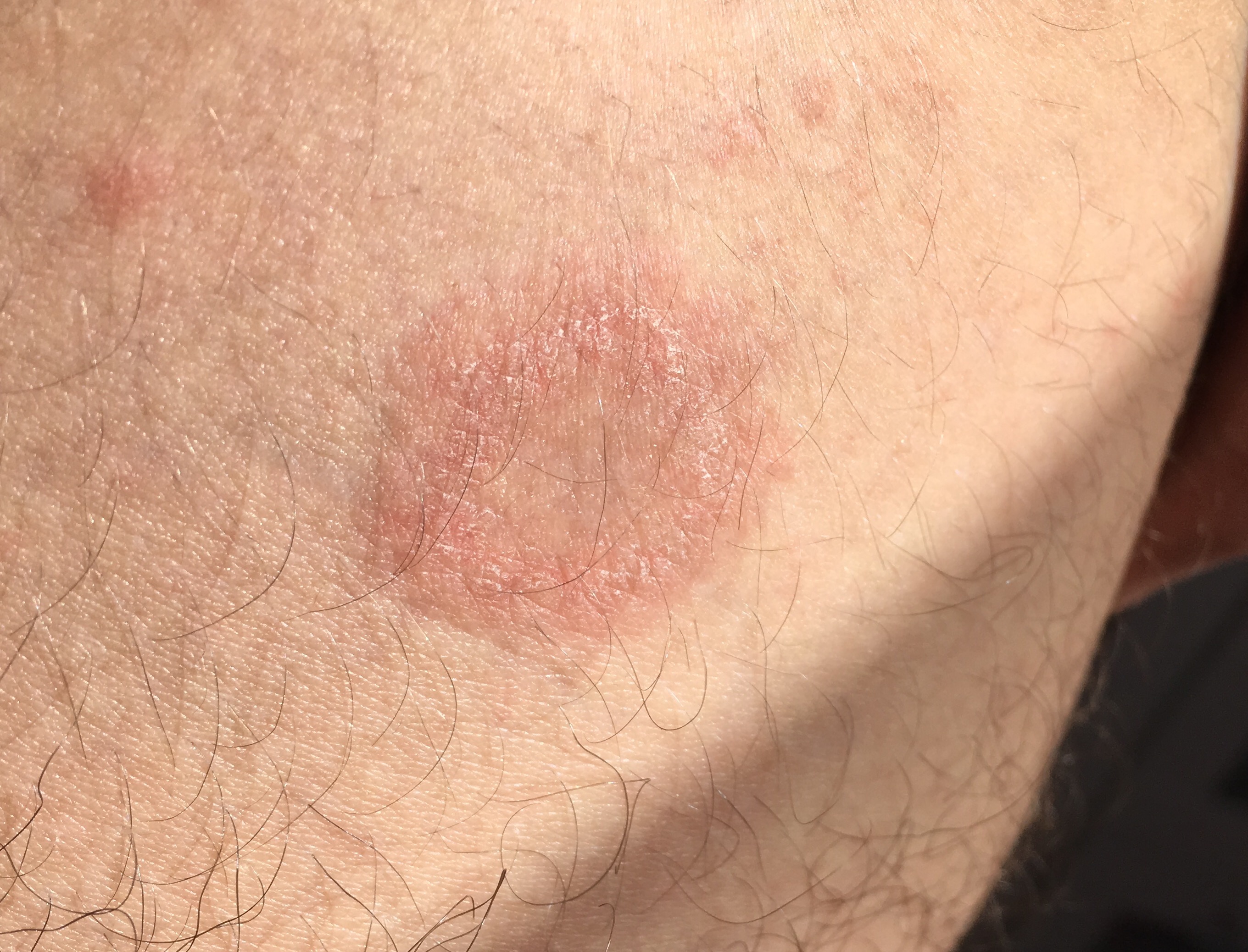 Zeckenbiss, Borreliose? Was kann es sein? (Haut, Hausarzt, Immunsystem) Zeckenbiss, Borreliose? Was kann es sein? (Haut, Hausarzt, Immunsystem)