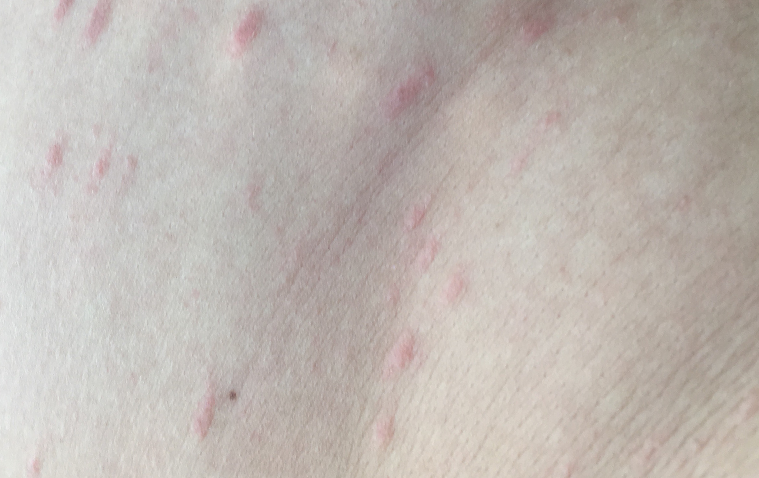 Zeckenbiss, Borreliose? Was kann es sein? (Haut, Hausarzt, Immunsystem) Zeckenbiss, Borreliose? Was kann es sein? (Haut, Hausarzt, Immunsystem)