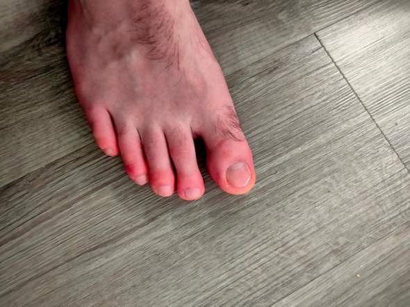 Zehen rot, angeschwollen und schmerzen, aber warum? (haut, füße Zehen rot, angeschwollen und Schmerzen, aber warum? (Haut, Füße
