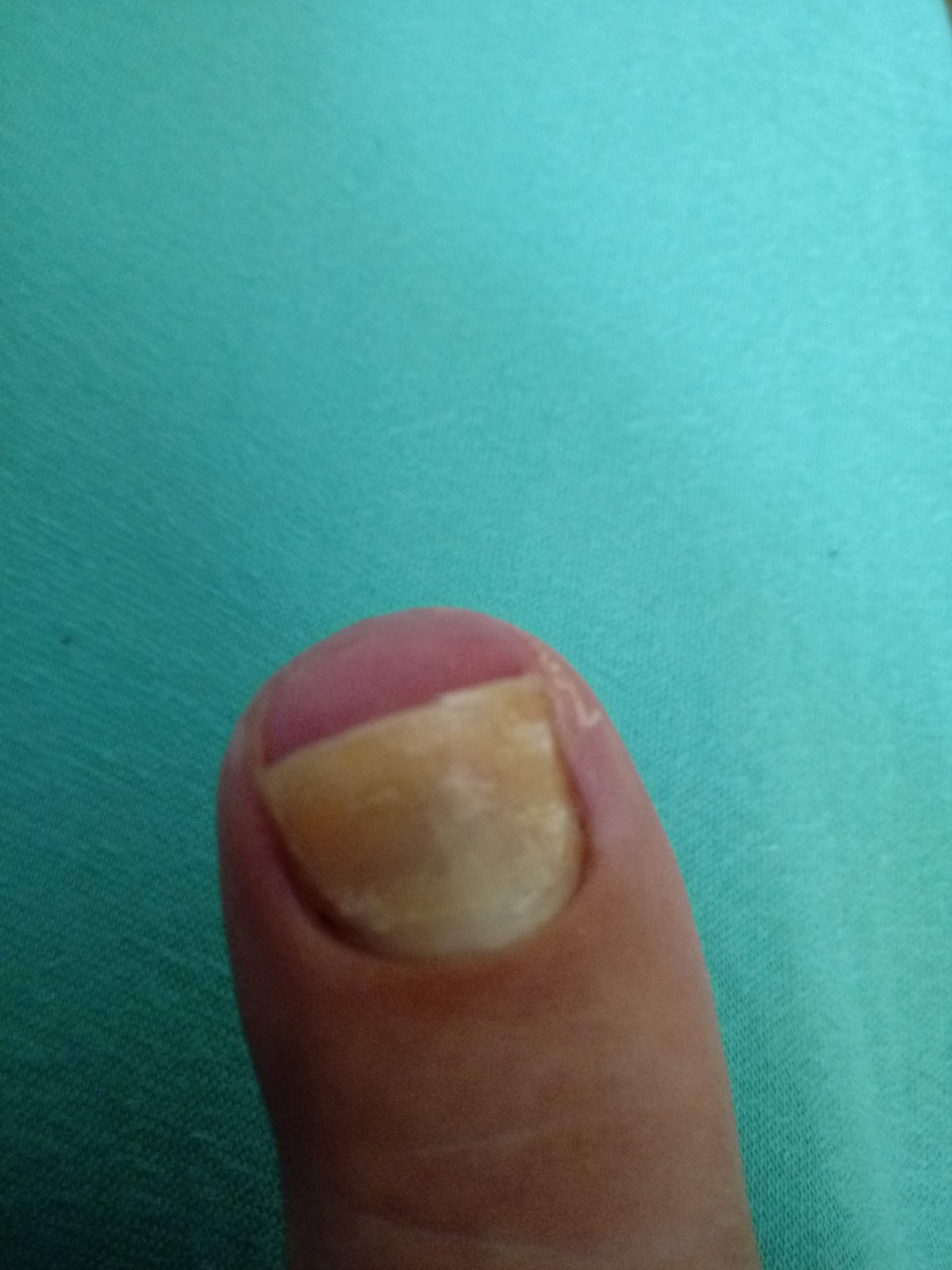 Zehennagel löst sich ab? (nägel, nagelbett) Zehennagel löst sich ab? (nägel, nagelbett)