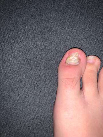 Zehnagel Lost Sich Fusse Zeh Hautarzt Zehnagel Lost Sich Fusse Zeh Hautarzt