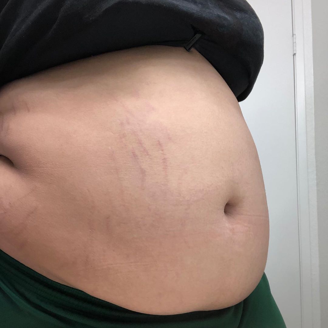 Zu Dicker Bauch Fur 14 Gewicht Fett Zunehmen Zu Dicker Bauch Fur 14 Gewicht Fett Zunehmen