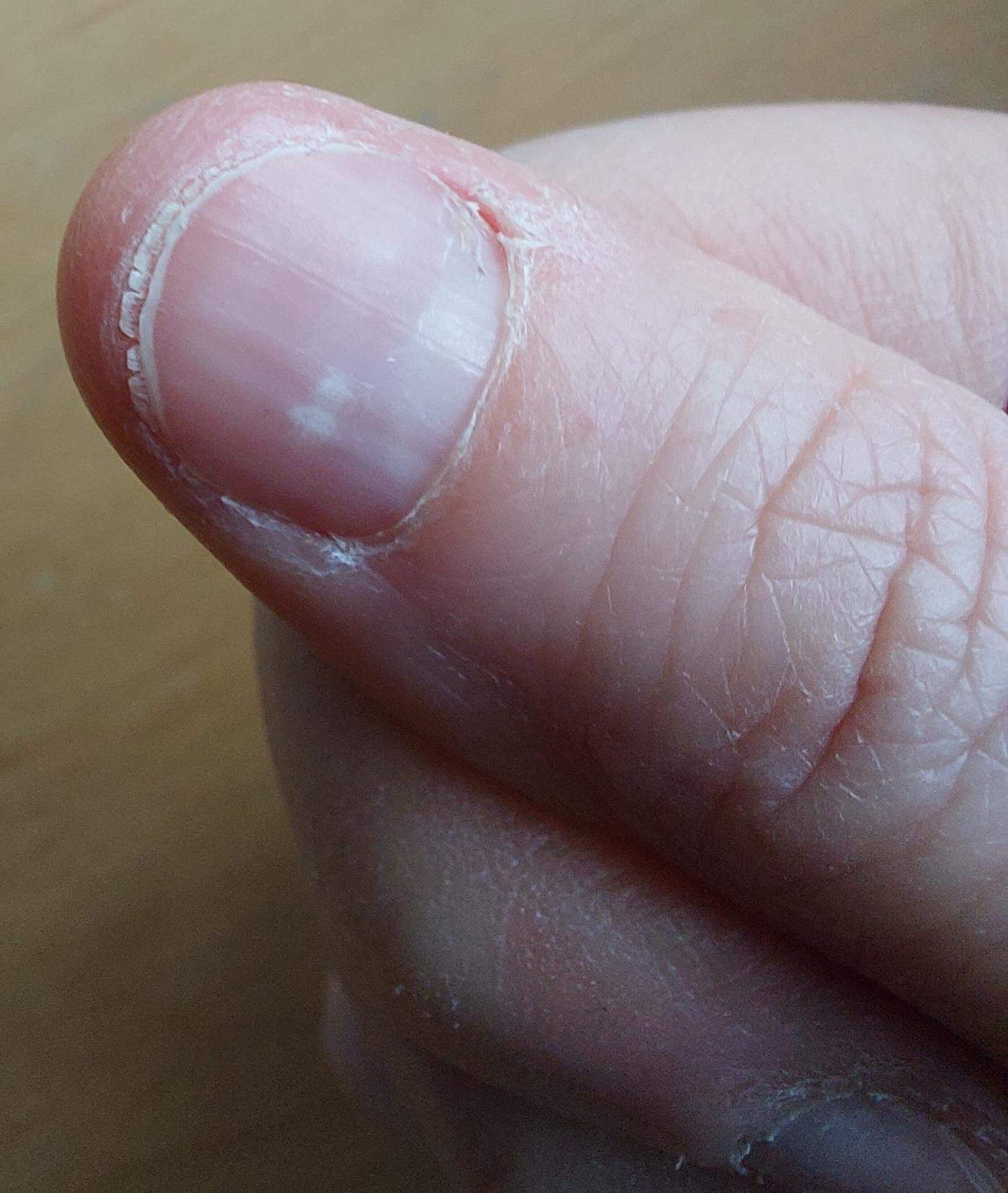 Zu starke Verhornung der Fingernägel - auch darunter - was tun