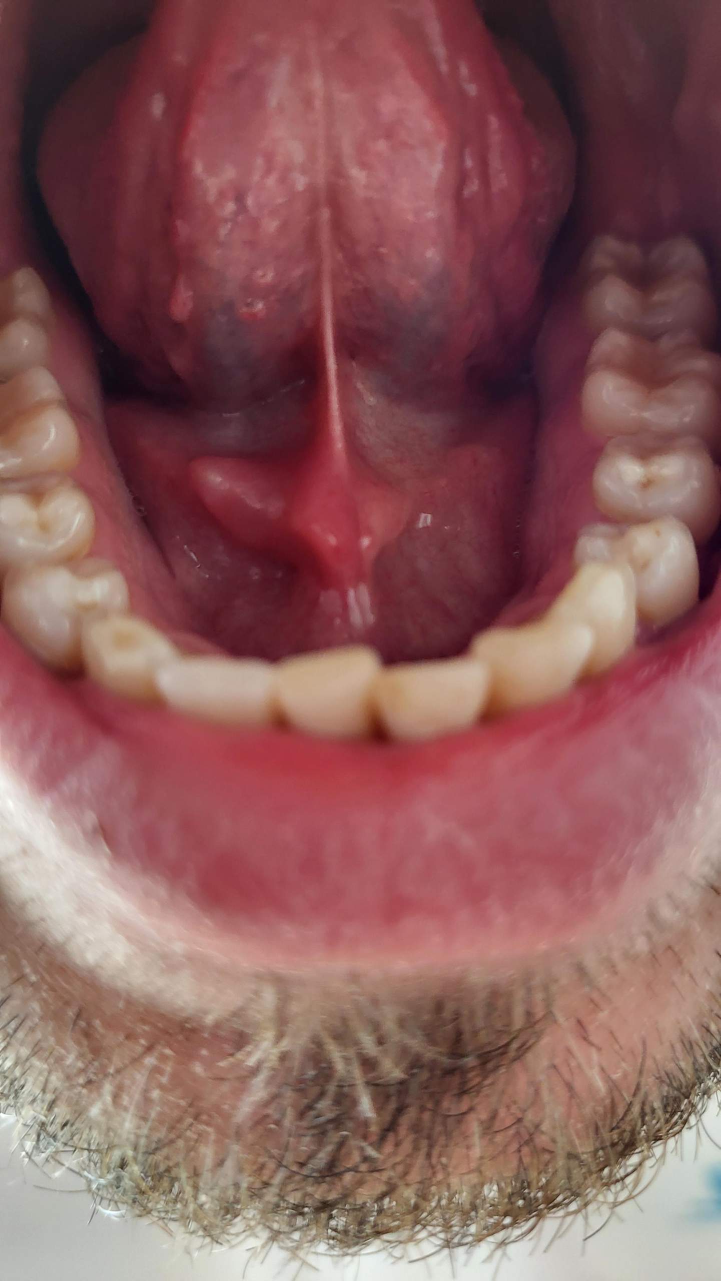 Zu welchem Arzt bei Hautlappen / Schwellung unter der Zunge? (zyste)