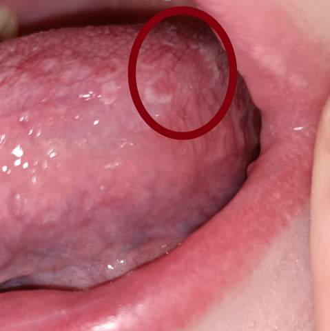 Zunge Krankheit?