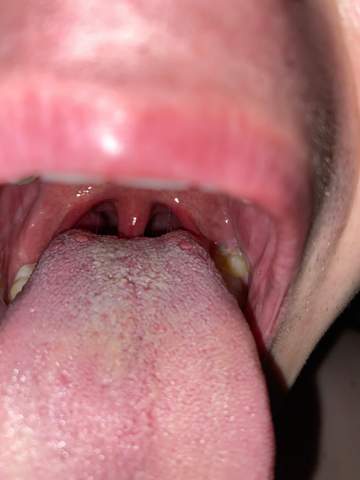 Zunge verfärbt und Knubbel?
