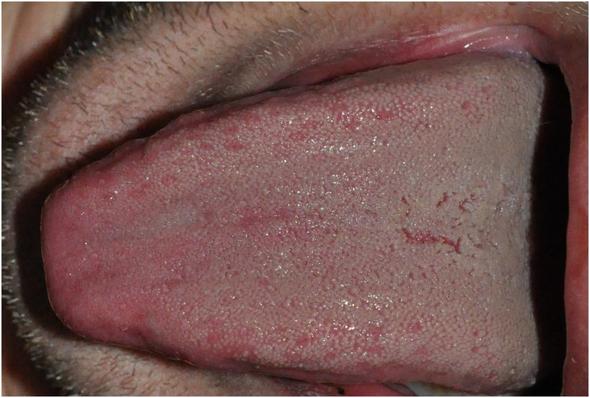 Zungenbelag Beauty Zunge Zungenbelag Beauty Zunge