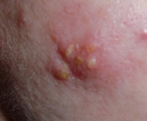 Zusammenhang Bakterielle Entzundung Der Haut Im Gesicht Und Nieren Schmerzen Antibiotika Bakterien