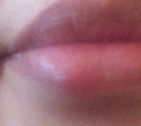 Zwei Pickelchen und rote Stelle auf der Lippe, was ist das?
