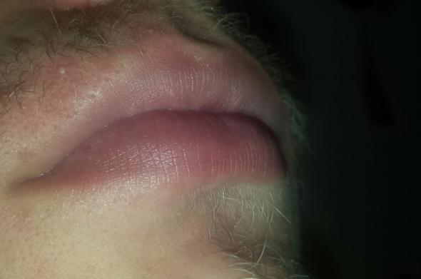 Lippen seitlich - (Lippe, Umfrage, Zyanose)